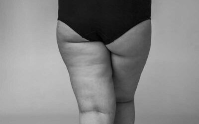 EST-CE QUE LA CELLULITE PART ?