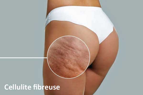 Cellulite fibreuse